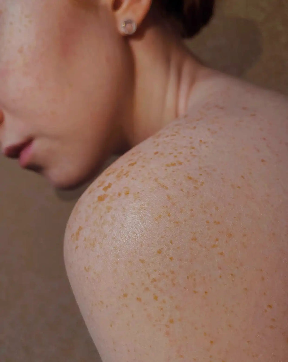 a woman with freckled skin
